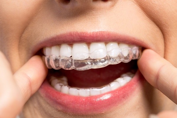 How-Does-Invisalign-Work How-Does-Invisalign-Work