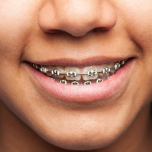latin girl's mouth with brackets