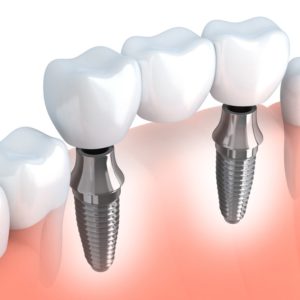 puente-o-implante-dental-Barcelona