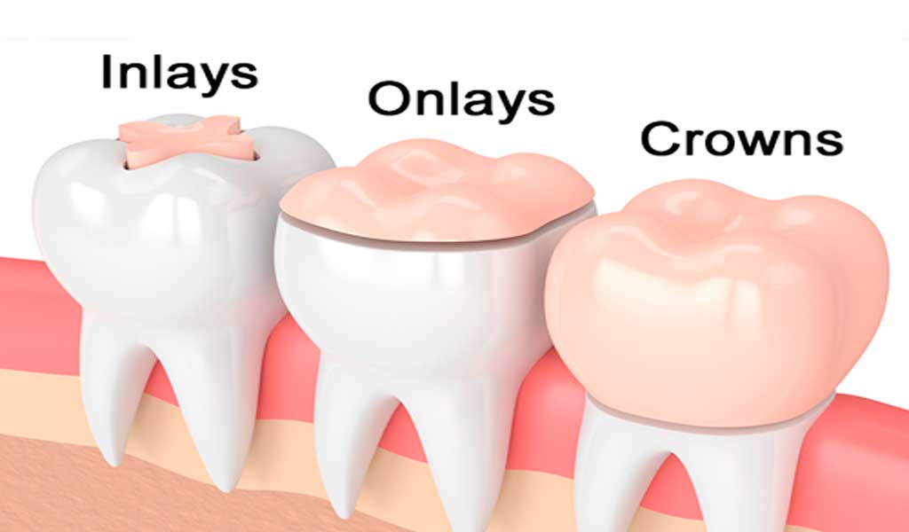 Inlays/Onlays: Estos son empastes dentales