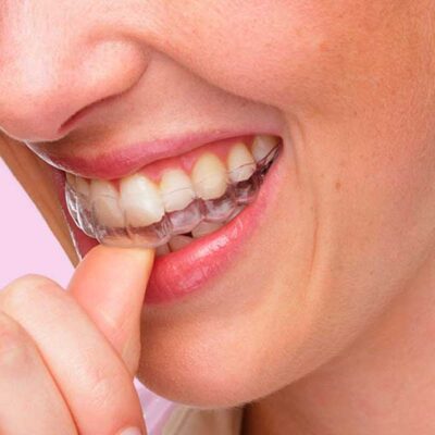 Ortodoncia invisalign Clinica dental Baldovi