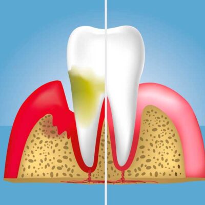 Tratamiento-de-periodoncia-en-Premia-de-Mar Tratamiento de periodoncia en Premia de Mar