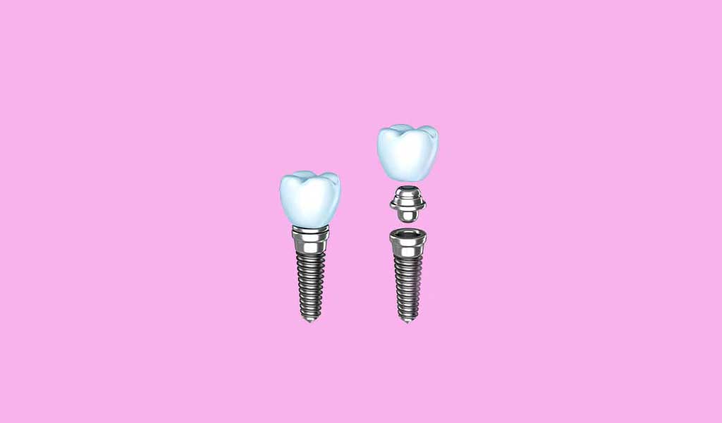 Implantes dentales individuales