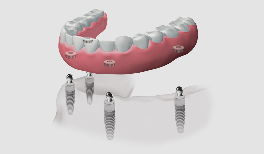 Dentaduras completas extraíbles