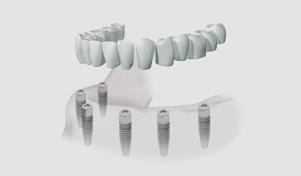 Dentaduras completas fijas en Premià de Mar