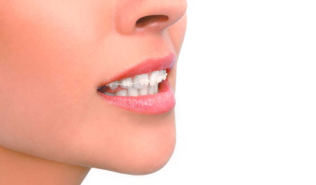 Ortodoncia estética Clínica dental en Premià de Mar