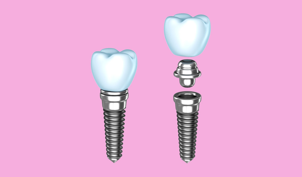 Implantes dentales individuales en Premià de Mar